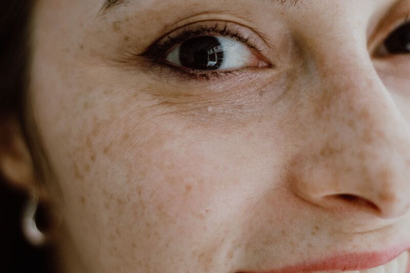 peau affectee par le stress oxydatif